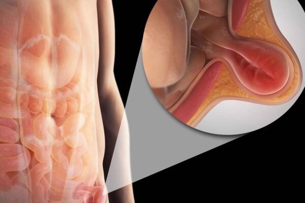 جراحة الفتاق| hernia surgery