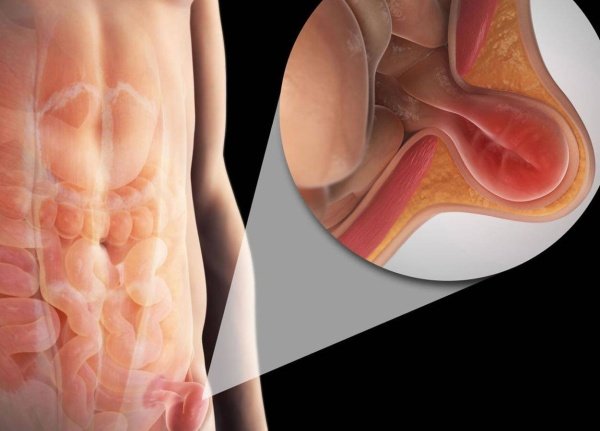 جراحة الفتاق| hernia surgery