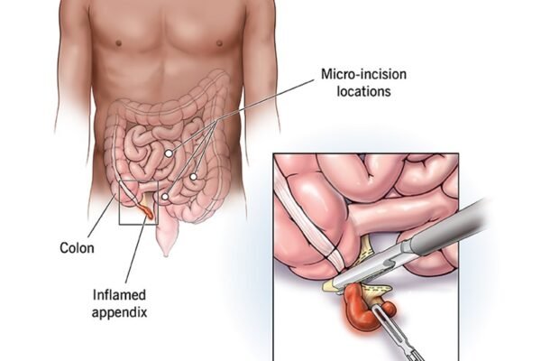 الزائدة| appendix surgery