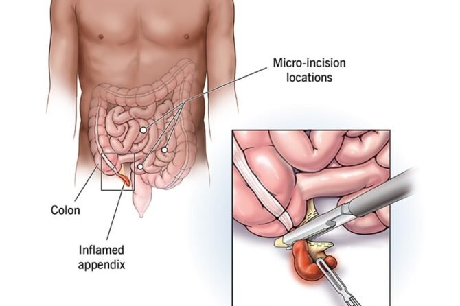 الزائدة| appendix surgery