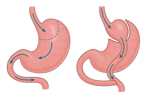 تحويل المسار| Gastric Bypass