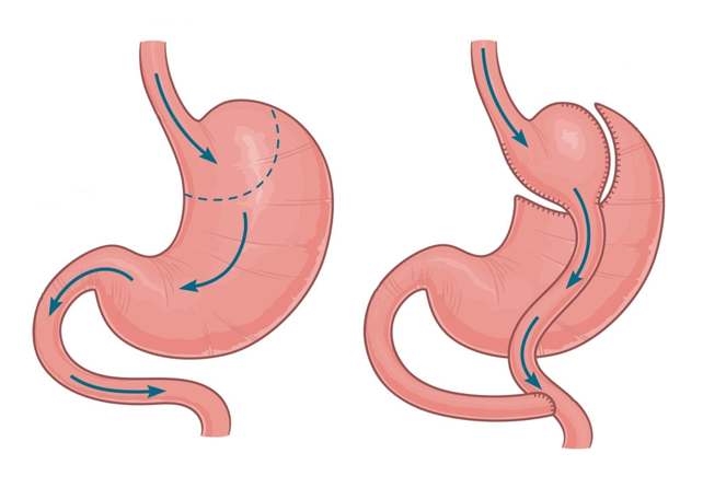 تحويل المسار| Gastric Bypass