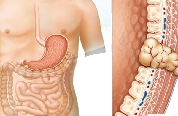 جراحة أورام الجهاز الهضمي| Gastrointestinal tumor surgery