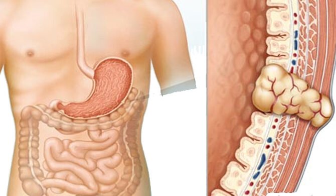 جراحة أورام الجهاز الهضمي| Gastrointestinal tumor surgery