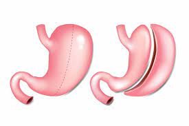تكميم المعدة| gastric sleeve