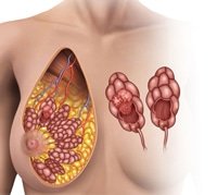 جراحة أورام الثدي| Breast tumor surgery